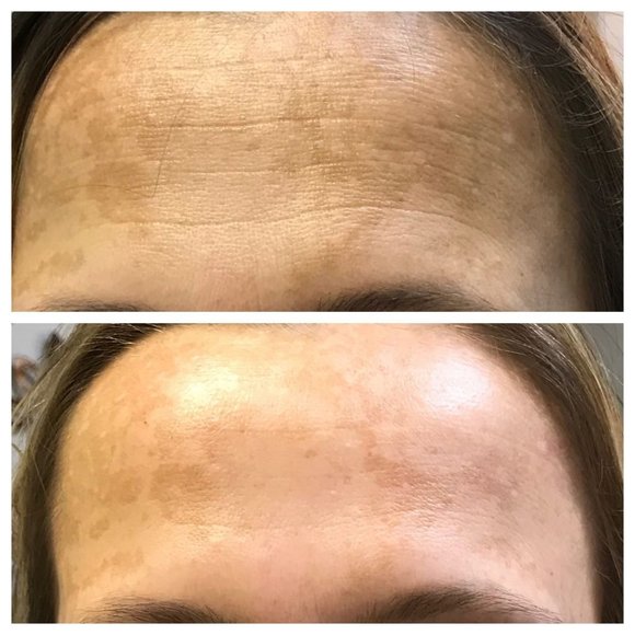 TCA Peel 20% Fine Lines, Dark Spots, Crepey Skin - Picture 5 of 6